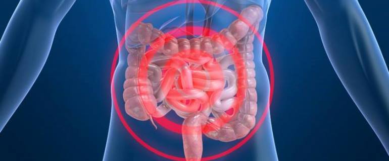 oclusion intestinal cancun